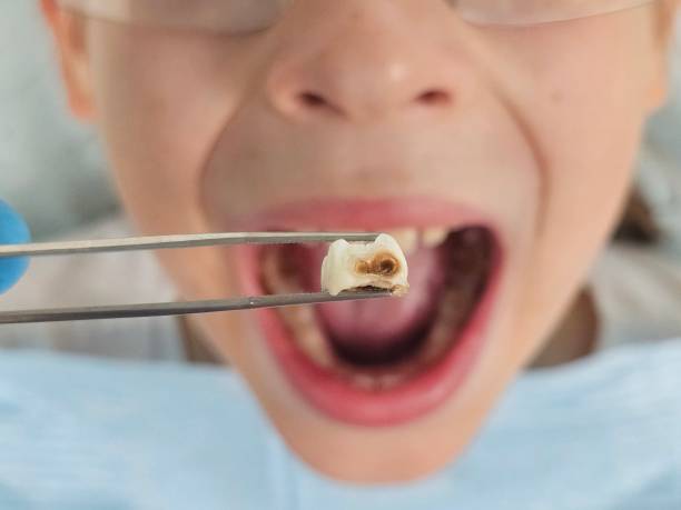 Best Emergency Treatment for Toothache in St Peter, WI