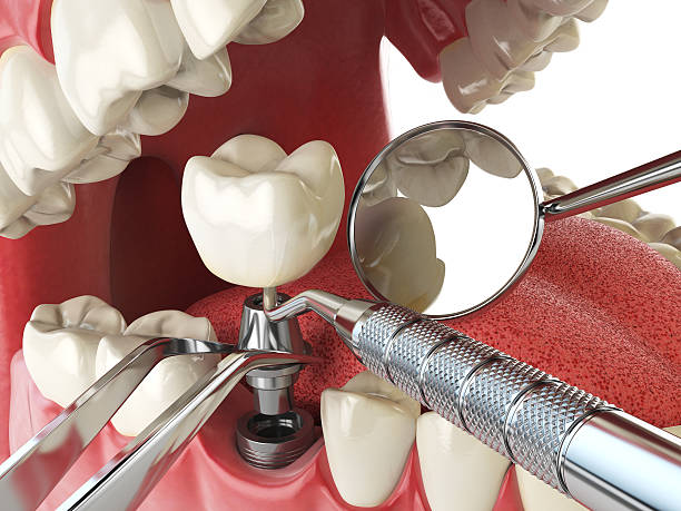 Best Emergency Tooth Extraction in St Peter, WI